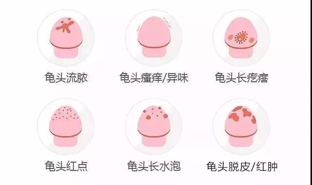 包皮龟头炎有哪些类型